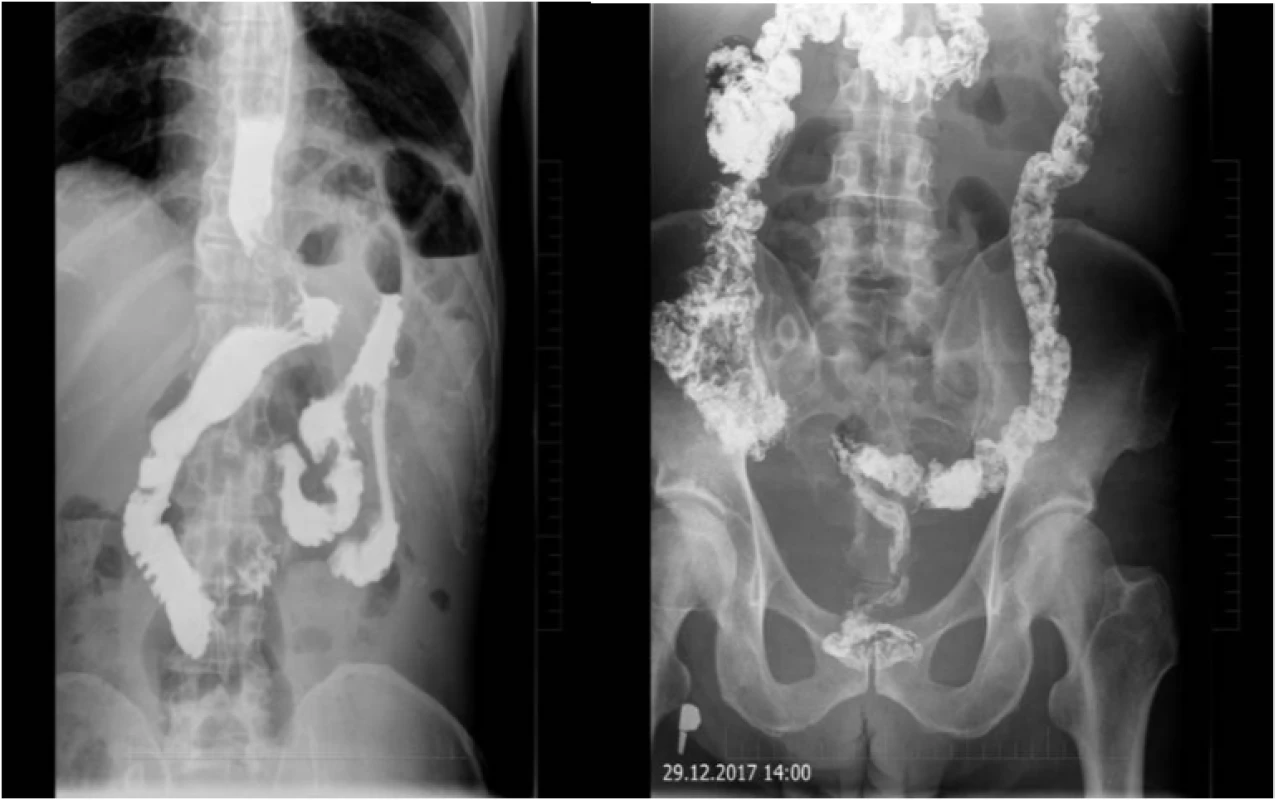 RTG pasáž tráviacim traktom – vpravo pozápalové zmeny hrubého čreva, vľavo obraz dilatácie pažeráka so zúžením v oblasti kardie a stagnáciou kontrastnej látky