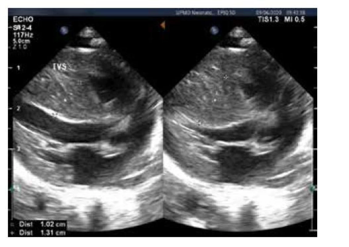 Echokardiografie, B obraz, hypertrofie myokardu,
měření šíře komorového septa v systole a diastole. Pacient
akceptorem při transfuzním syndromu dvojčat, komplikovaném
akutní fetofetální transfuzí po úmrtí dvojčete. Těžká anemie
korigována transfuzí in utero
