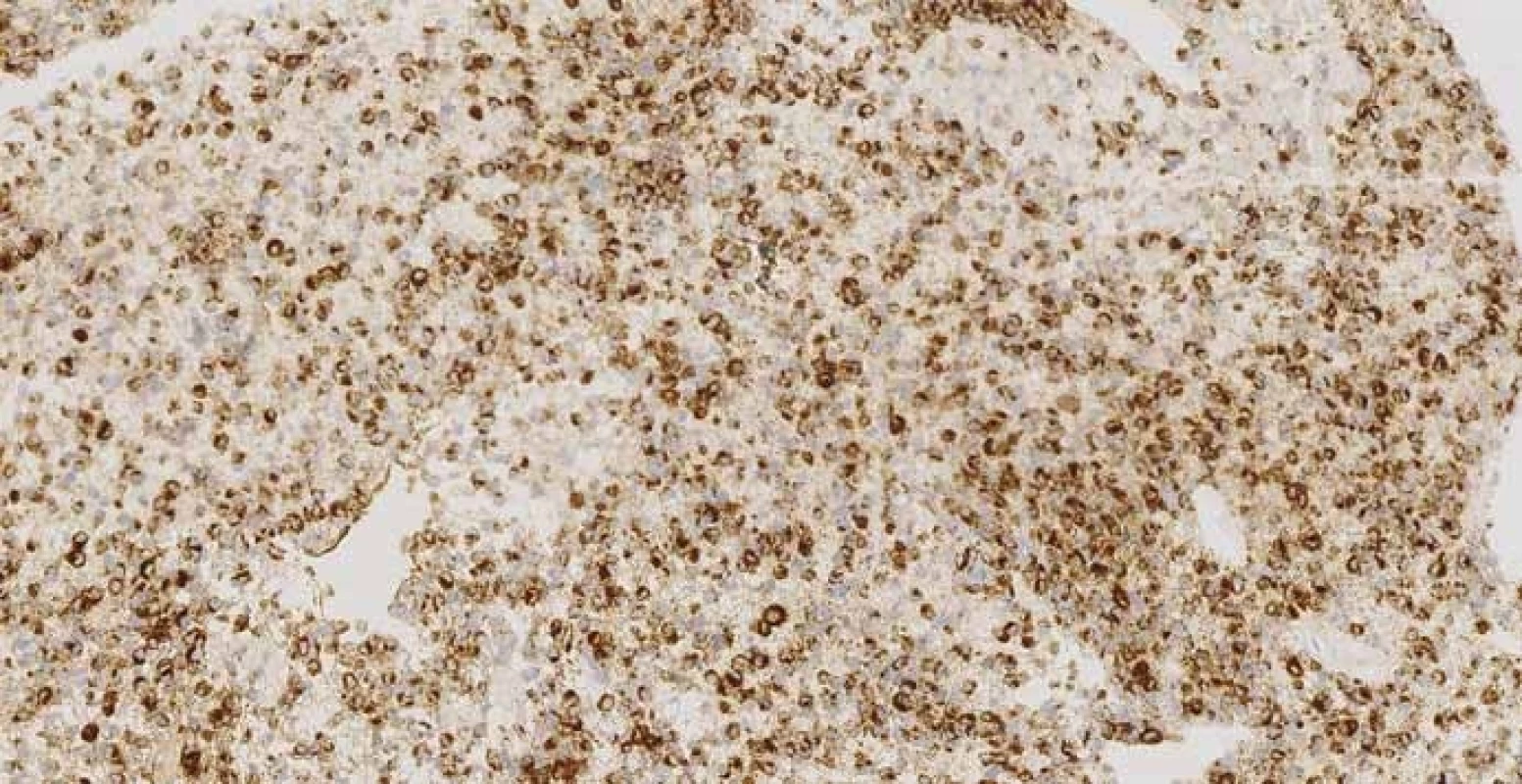 Imunohistochemistry – strong granular cytoplasmic positivity of HMB-45 (melanocytic differentiation marker) in 80% of malignant cells in pancreatic biopsy obtained via EUS-FNA, magnification ×200. <br>Obr. 5. Imunohistochemie – silná granulární cytoplazmatická pozitivita HMB-45 (marker melanomové diferenciace buněk) v 80 % maligních buněk z biopsie pankreatu, zvětšeno 200×.
