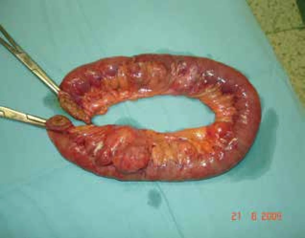 Tenké střevo po resekci<br>
Fig. 2: Small bowel after resection