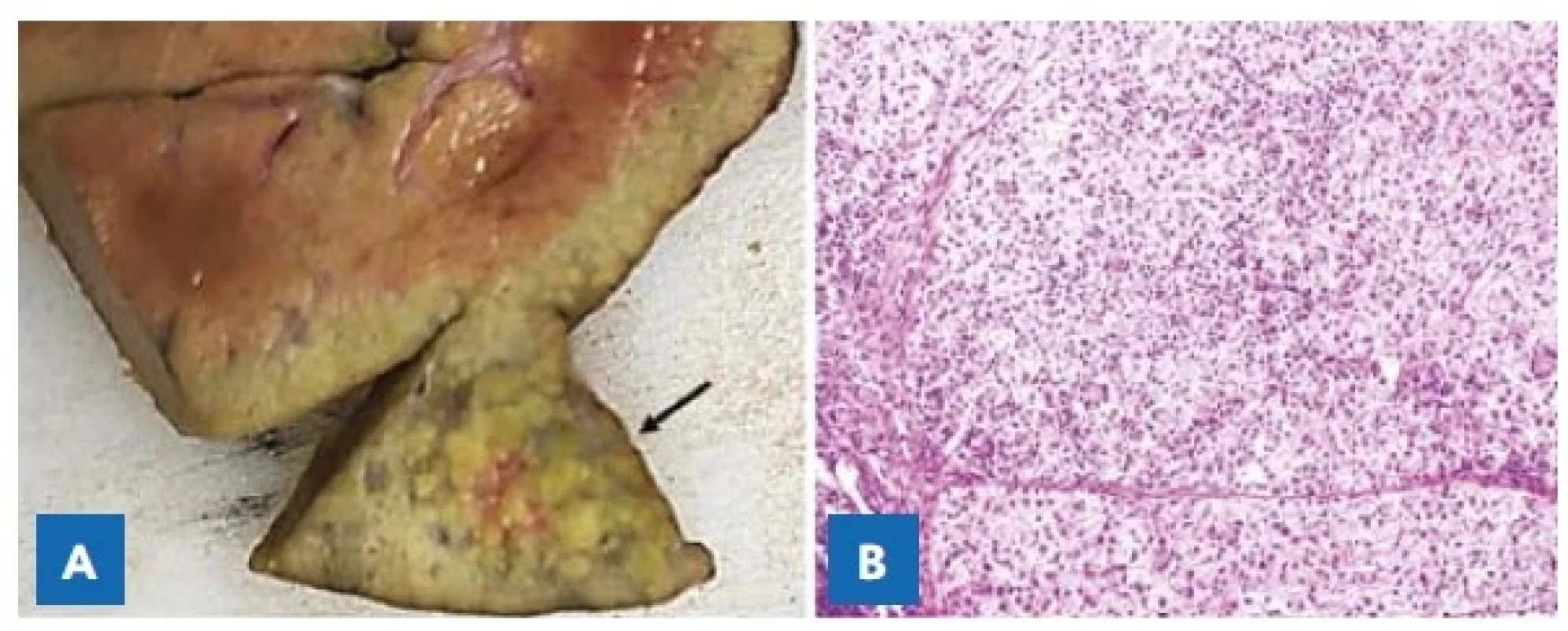 A – Solitární ložisko hepatocelulárního karcinomu (šipka)
v levém laloku jater u čtrnáctiměsíčního chlapce s tyrosinemií typ 1.<br>
B – Mikroskopický obraz dobře diferencovaného hepatocelulárního
karcinomu. Hematoxylin-eozin, pův. zvětšení 400×.