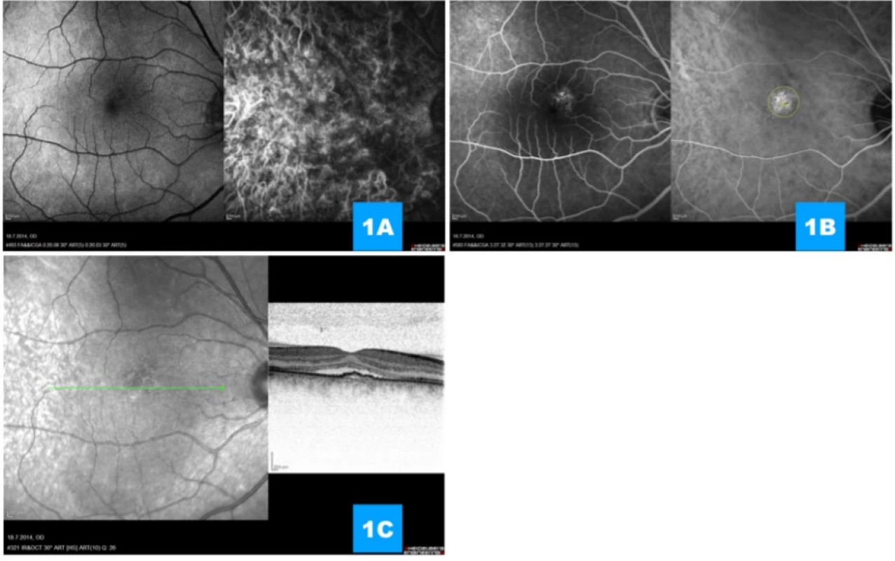 (A) Simultaneous fluorescence and indocyanine angiography in prearterial and
(B) late venous phase of angiogram displays rounded subfoveal deposit of gradual hyperfluorescence with demarcated
width of beam for photodynamic therapy (yellow outlining), on angiogram there are no signs of choroidal neovascularisa- tion (C) Transfoveal linear scan demonstrating undulating line of retinal pigment epithelium, subretinal fluid and relatively
well preserved individual retinal layers