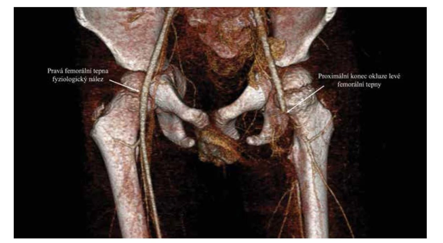 CT angiografie, trojrozměrná rekonstrukce. Zachycena neprostupující kontrastní látka při okluzi levé femorální
tepny.<br>
Fig. 3. CT angiography, three-dimensional reconstruction. Occlusion of the left femoral artery.