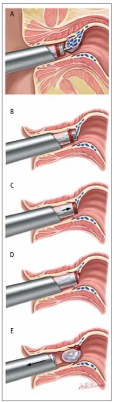 Technika použití elastické ligatury k léčbě
vnitřních hemoroidů. [Upraveno podle: UpToDate]<br>
(A) kleště, kterými se uchopí hemoroid.<br>
(B) je boční pohled na kleště uchopující hemoroid.<br>
(C) ukazuje vtažení kleští a hemoroidu do ligátoru.<br>
(D) ukazuje hemoroid protažený bubínkem a gumičku
přiloženou na bázi hemoroidu. Kleštěmi je
hemoroid jemně tažen, aby byl zajištěn, zatímco je
páska uvolněna z ligátoru.<br>
Na obrázku (E) je znázorněn podvázaný hemoroid.