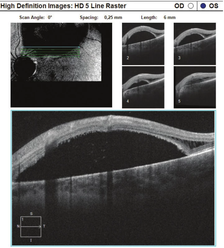 HD-OCT: Linear horizontal trans-retinal scan of left
eye conducted in superotemporal peripapillary region,
with evident extensive area of high serous ablation of neuroretina
with accumulation of fluid sub-retinally, in temporal
regions again evident schisis of retinal layers