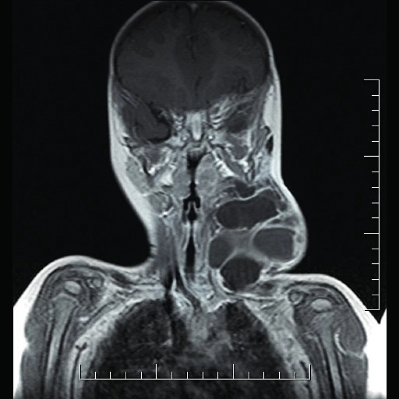 Lymfatická malformácia laterocervikálnej oblasti krku
vřavo - MRI vyšetrenie (T1 váženie).