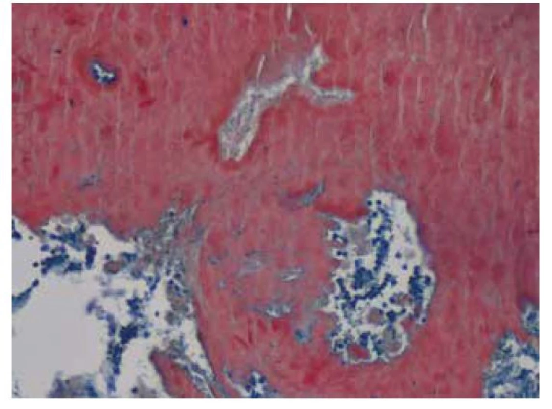 Amorfní depozita Kongofilního materiálu – amyloidu ve speciálním
barvení Kongo červeň zcela setřela základní strukturu plicního parenchymu.
V levém horním rohu při okraji snímku je patrná pouze drobná
krevní céva, jejíž stěna je taktéž prostoupena amyloidem. V polarizačním
vyšetření vykazují amyloidová depozita birefringenci a dichroismus, vlastnosti
charakteristické pro amyloid. Původní zvětšení snímku 100x