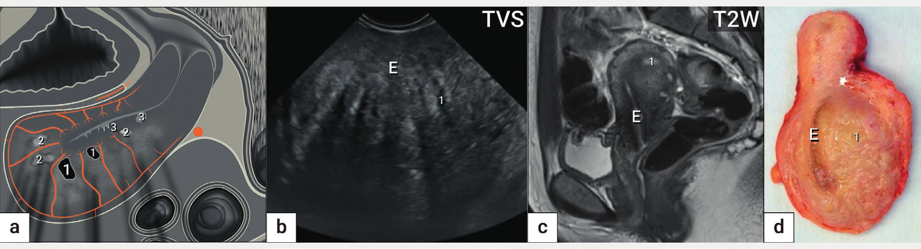 Adenomyóza<br>
Ultrazvukové schéma adenomyózy zadní stěny děložní (a) zobrazující asymetricky zesílenou zadní stěnu děložní na podkladě špatně
ohraničené léze s nehomogenní strukturou s cystickými projasněními (1), hyperechogenními ostrůvky (2), projekcemi endometria do myometria
(3) a jemnými akustickými stíny. Ultrazvukový nález (b), nález z magnetické rezonance (c) a intraoperační nález (d).
E – endometrium, TVS – transvaginální sonografie, T2W – T2 vážené obrazy v magnetické rezonanci