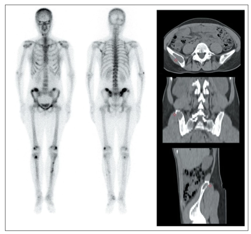 Scintigrafie skeletu a CT u 33leté pacientky s PHPT s hnědými tumory ve skeletu.
Vlevo: celotělová scintigrafie skeletu pomocí 99mTc-HDP (v přední a zadní projekci) s vícečetnými
ložisky patologicky zvýšené akumulace radiofarmaka zejména v oblasti lebky,
v levé lopatce, v pánvi a kostech dolních končetin.<br>
Vpravo: CT vyšetření pánve téže pacientky s průkazem vybraného osteolytického ložiska
v oblasti pravé kosti kyčelní v axiálním, koronálním a sagitálním řezu.