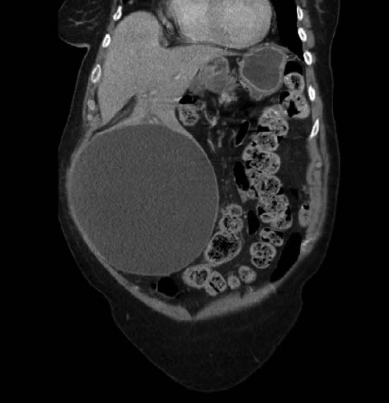 CT obraz objemné jaterní cysty – koronální rovina<br>
Fig. 2: CT scan of a large liver cyst – coronal view
