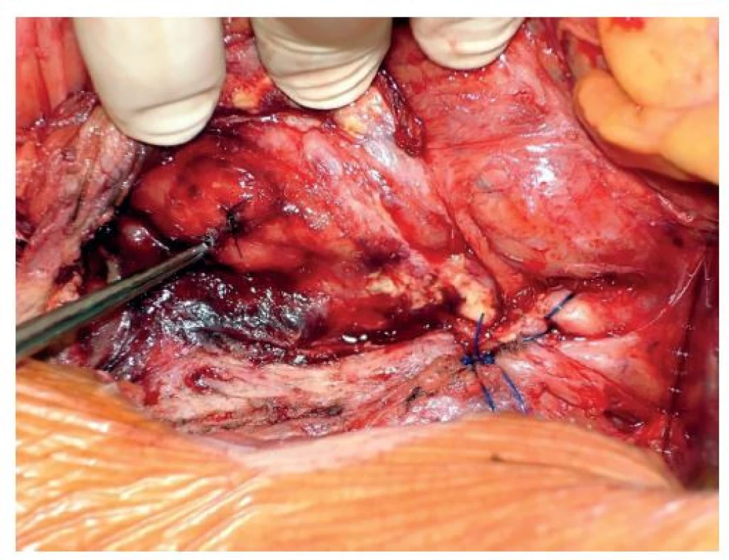 Slepý uzávěr subrenální aorty a sutura duodena<br>
Fig. 2: Blind closure of the subrenal aorta and suture of
the duodenum