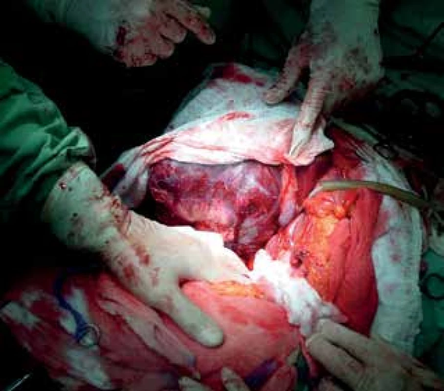 Velký nádor jater<br>
Fig. 3: Large liver tumor