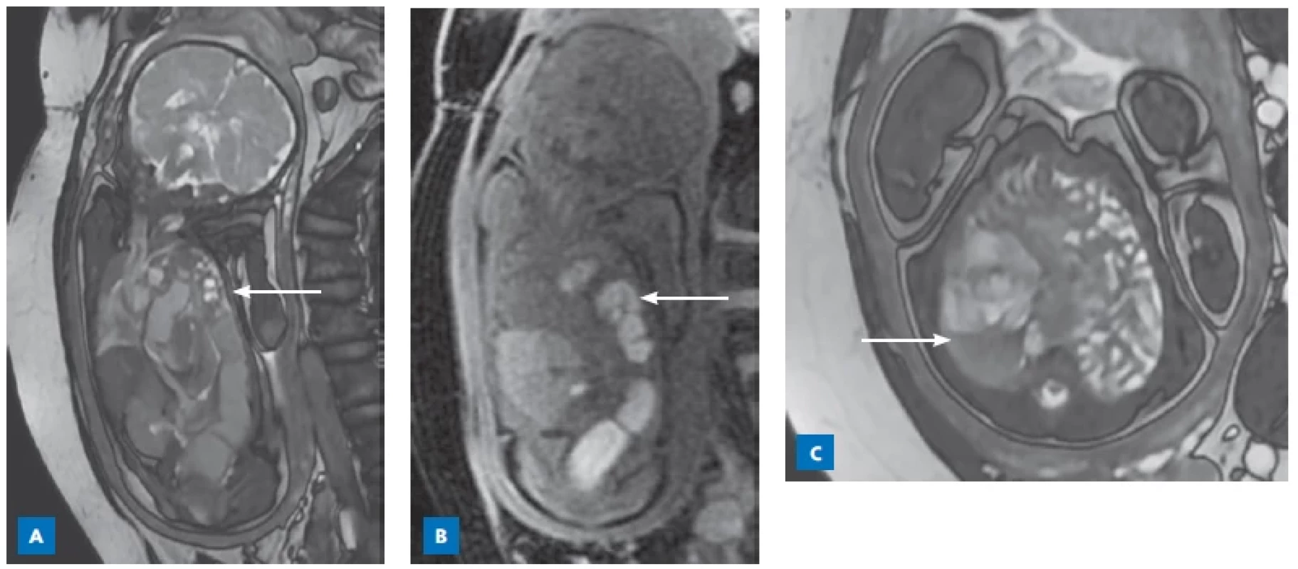 A 40-week-old fetus with no prenatal care presents with a large left hemidiaphragmatic hernia. A – Coronal Fast Image Employing
Steady State Acquision (FIESTA ) image demonstrating the absence of the left hemidiaphragm with partial herniation of the liver, colon, and small
bowel loops in to the left hemithoracic cavity (arrow) causing mediastinal shift towards the left. B – Coronal Liver Acceleration Volume Acquisition
(LAVA, T1-weighted) image demonstrating herniated meconium-filled colon within the left hemithoracic cavity (meconium has high T1 signal)
(arrow). C – Axial FIESTA image demonstrating fluid-filled small bowel loops in the left hemithoracic cavity and displaced mediastinal structures
towards the right; a portion of the right lung can be partially seen in this image (arrow).