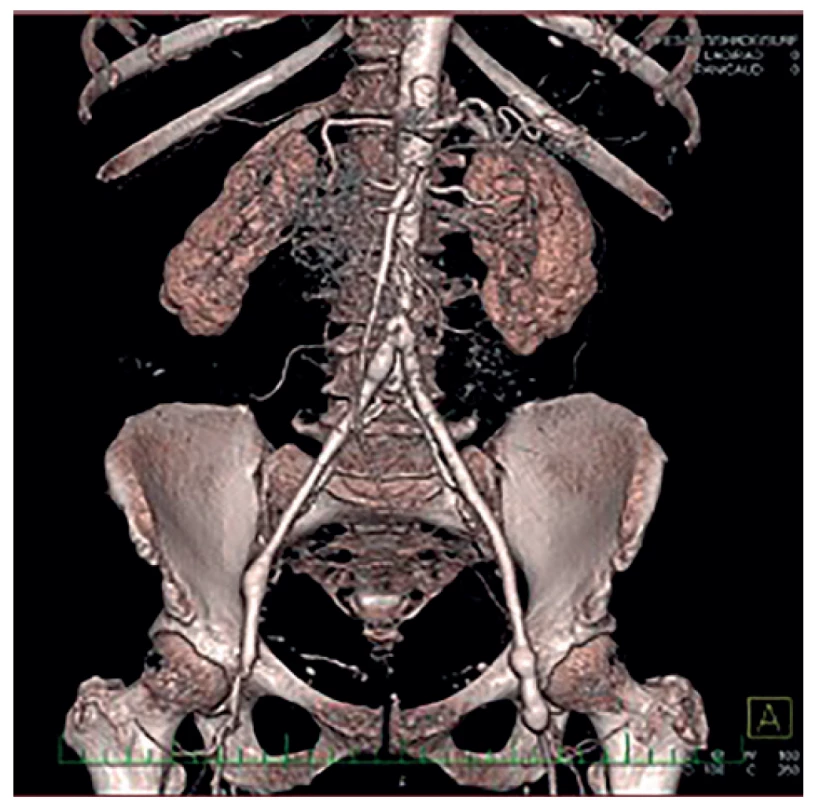 Autologní neograft pomocí hluboké femorálních žil <br>
Fig. 2: Neoaortoiliac System (NAIS) procedure (VFS)