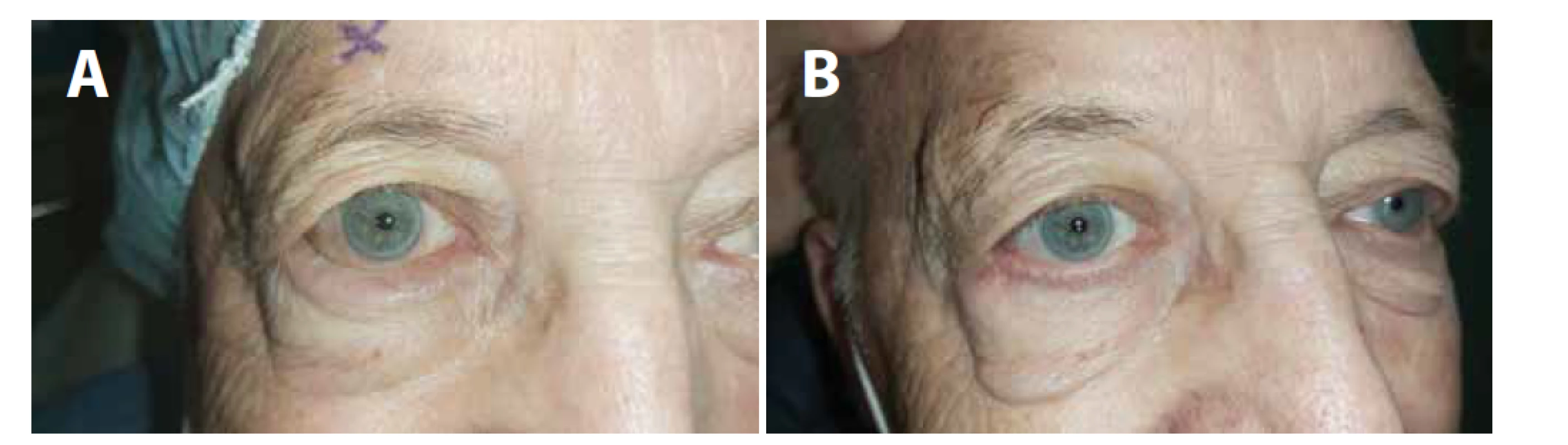 (A) Entropium pravého oka – stav před operací, (B) stav po operaci