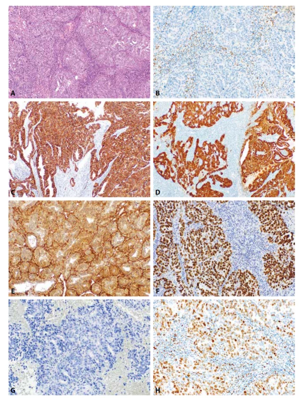 Endometriální serózní karcinom. Převážně solidně uspořádaný nádor s minoritními oblastmi glandulární úpravy (HE, 100x). Nádorové
struktury jsou negativní při průkazu estrogenových receptorů (3B, 200x). Difúzní pozitivita IMP3 (3C, 200x) a difúzní („bloková“) exprese p16
(3D, 100x). Glandulárně uspořádaný serózní karcinom s difúzní pozitivitou PTEN (3E, 100x). Příklady aberantního typu exprese p53 v serózním
karcinomu: silně intenzivní jaderná pozitivita téměř ve 100 % nádorových buněk (3F, 200x) a úplná ztráta exprese p53 v nádorových buňkách
s pozitivní vnitřní kontrolou v ojedinělých stromálních elementech (3G, 200x). Serózní karcinom s vysokou proliferační aktivitou přesahující 70 %
(Ki-67, 200x).