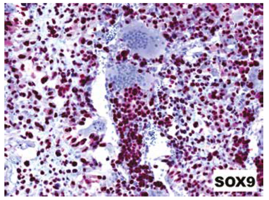 Difúzní jaderná pozitivita s protilátkou SOX9 přítomná jak v chondroidních
oblastech, tak v malých stromálních buňkách dělících sept; reaktivní
osteoklasty byly vždy negativní (IHC; 200x).