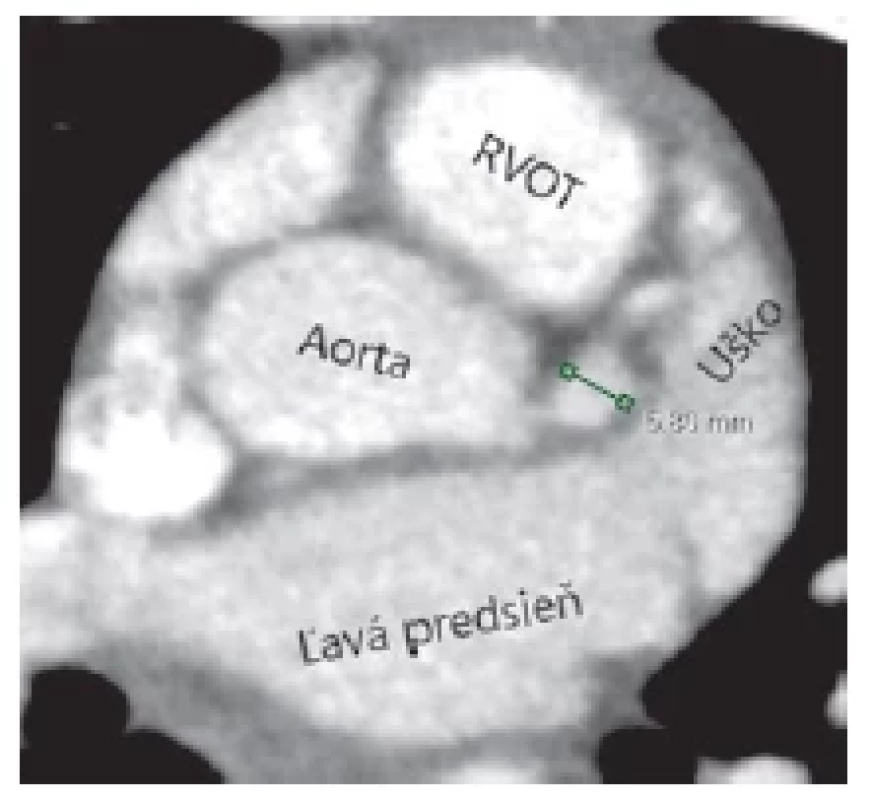 CTA 10-ročného
pacienta dlhodobo sledovaného
po prekonaní
Kawasakiho choroby.
Axiálna rovina. Zelená
úsečka ukazuje diameter
aneuryzmaticky dilatovanej
ľavej koronárnej artérie.
Na základe jej nameraného
diametra a jeho
zaindexovaní na povrch
tela bola u pacienta podľa
aktuálnych odporúčaní(14)
zmenená antikoagulačná
liečba na duálnu antitrombotickú
liečbu.