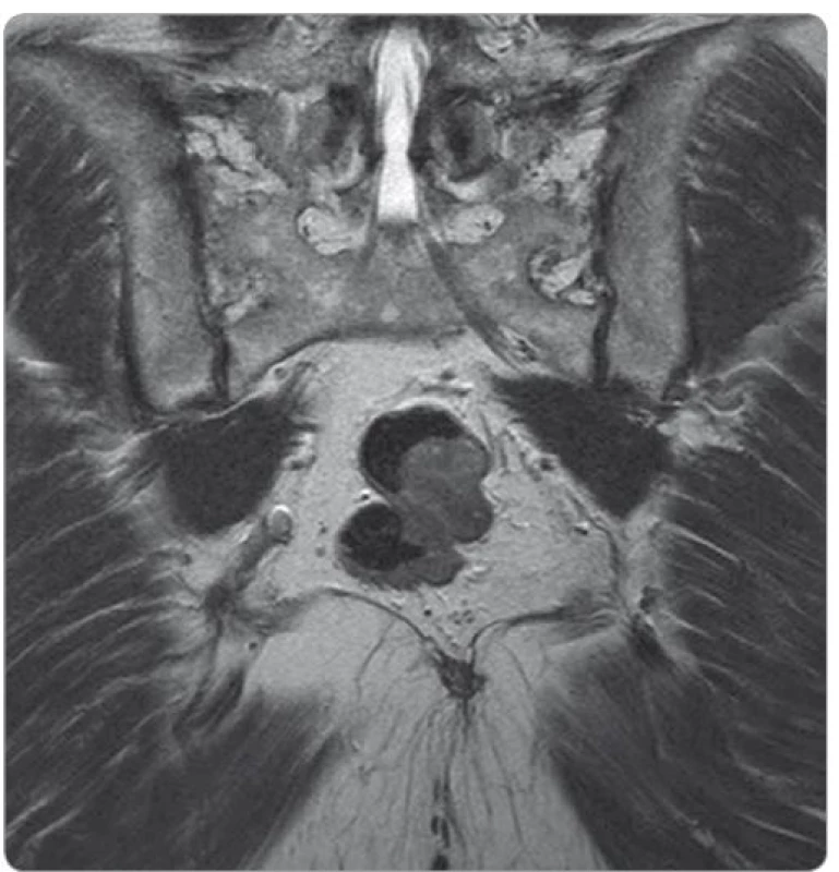 MRI vyšetření – gastrointestinální stromální tumor rekta