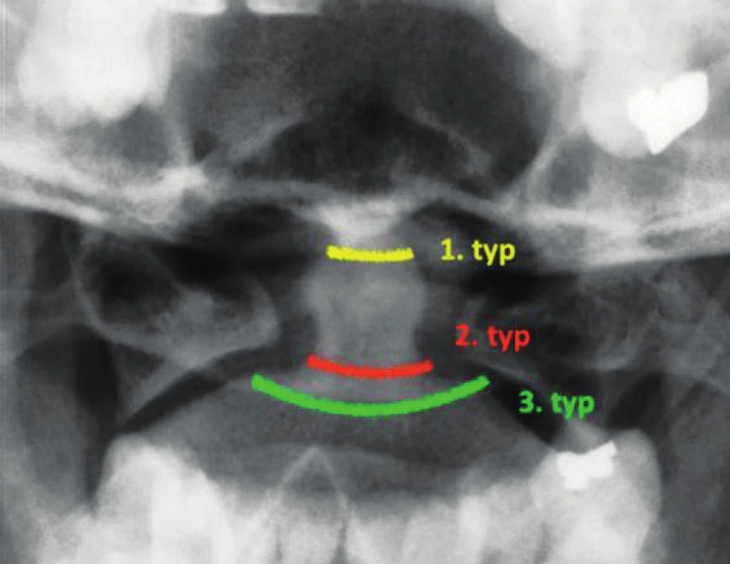 RTG Transorální projekce horní krční páteře. Barevně jsou zaznačeny typy zlomenin dentu dle Anderson D’Alonzovy klasifikace. Žlutá barva značí 1. typ zlomeniny v oblasti apexu dentu, červená barva pak 2. typ v oblasti baze dentu a zelená barva zobrazuje 3. typ zlomeniny, který zasahuje z baze do těla C2 obratle