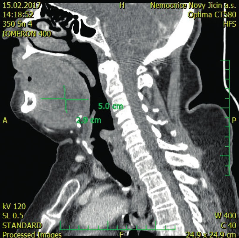 CT (kontrastní) vyšetření, kde fokální prosáknutí (5x2,9
cm) v oblasti kořene jazyka a spodiny ústní dutiny.