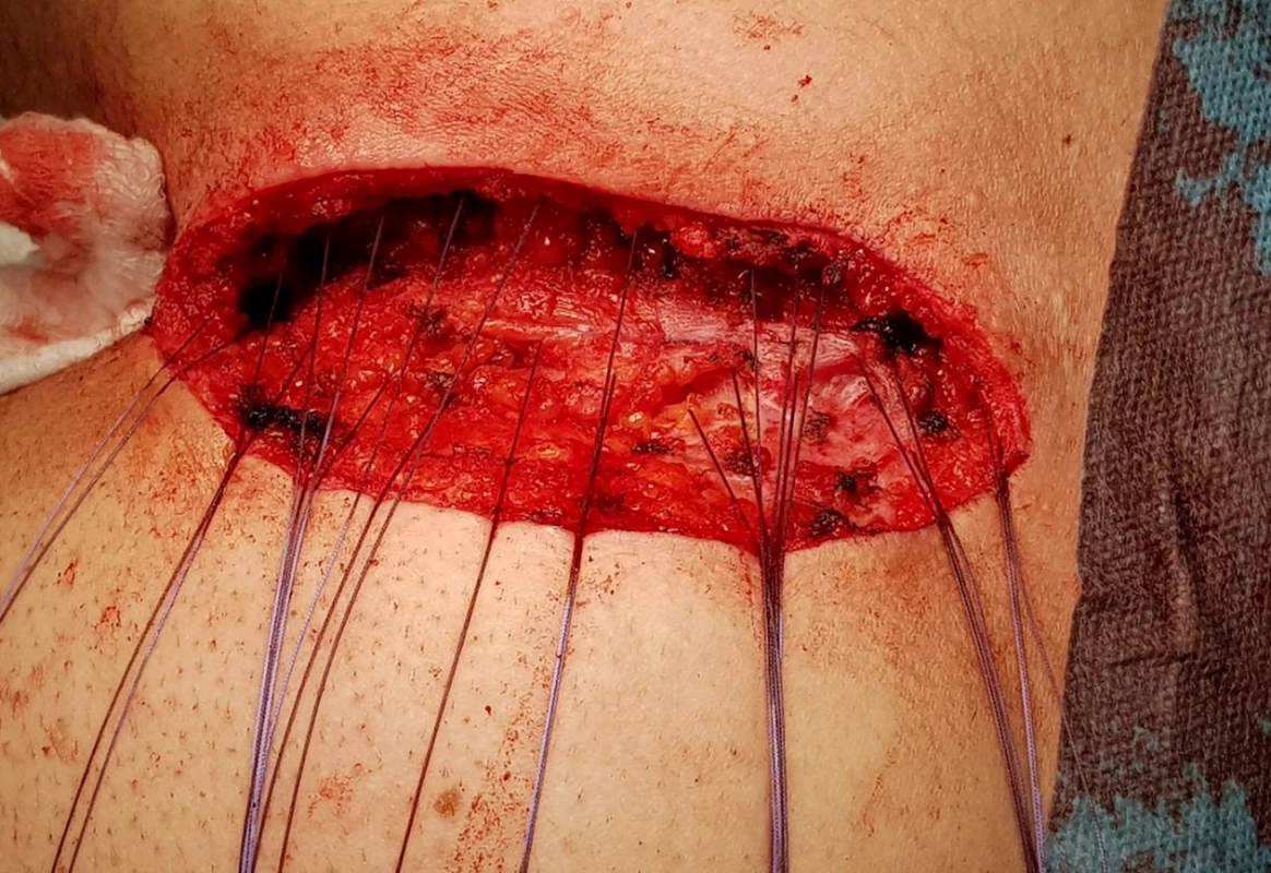 První vrstva stehů<br>
Fig. 5: First layer of the suture