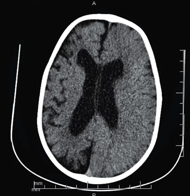 CT mozgu (vo veku 2 r. 3 mes.) – difúzna kortikálna
atrofia pravej mozgovej hemisféry, so sekundárne priestrannejším
komorovým systémom, progresia nálezu.<br>
Fig. 2. Brain CT (age 2 years 3 months) – diffuse cortical
atrophy of the right brain hemisphere with ventricular
enlargement, progression of findings.
