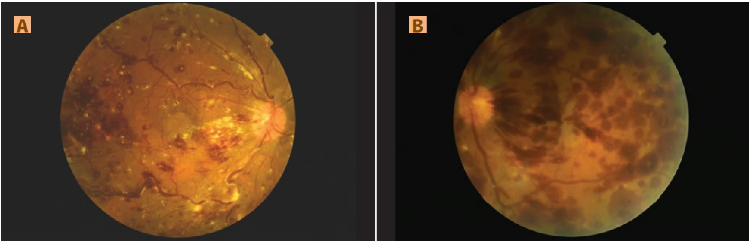 Nález na fundu pravého (A) a levého (B) oka: fundus se skvrnitými, plaménkovitými hemoragiemi a Rothovými skvrnami,
od střední periferie obraz shluků tvrdých exsudátů, vény výrazně dilatované a tortuózní s viditelnými bělavými hmotami v krvi,
(B) rozsáhlejší hemoragie a méně tvrdých exsudátů