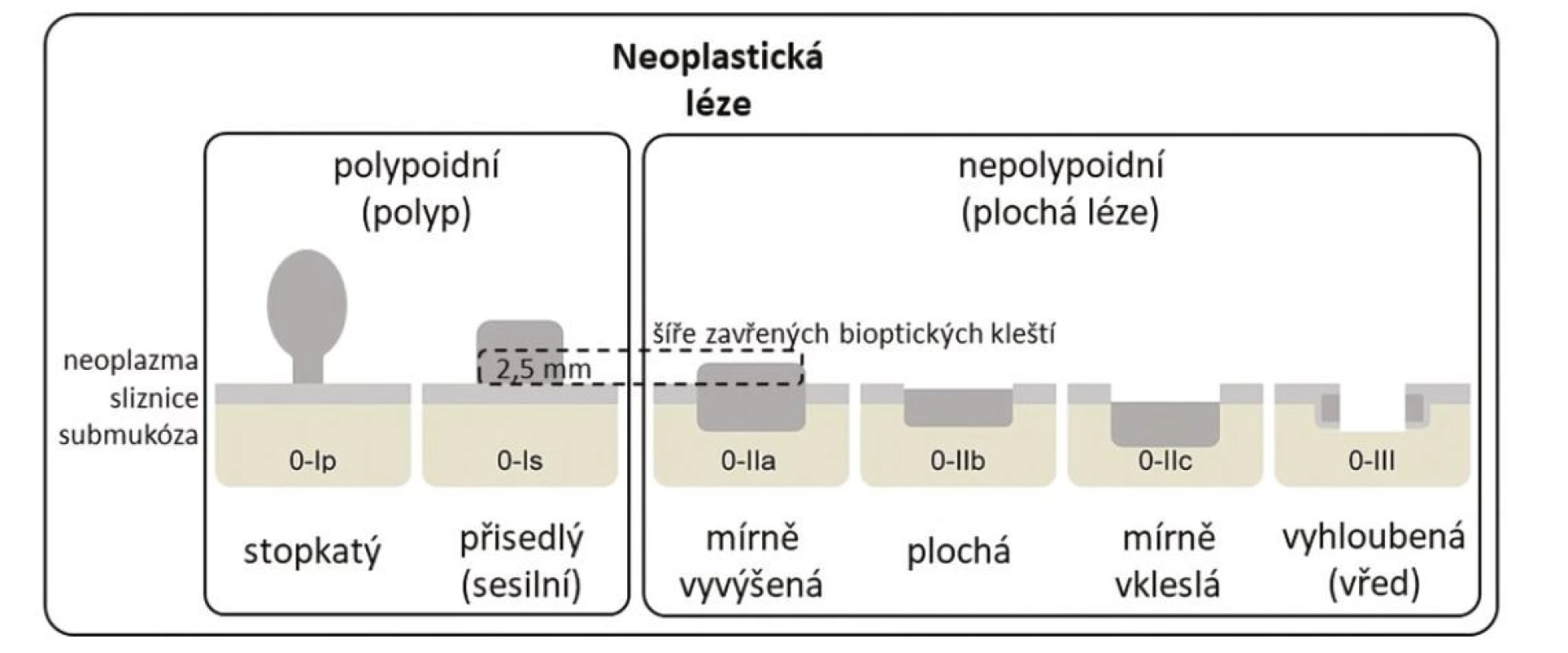 Pařížská klasifikace povrchových neoplastických lézí, upraveno podle (5)