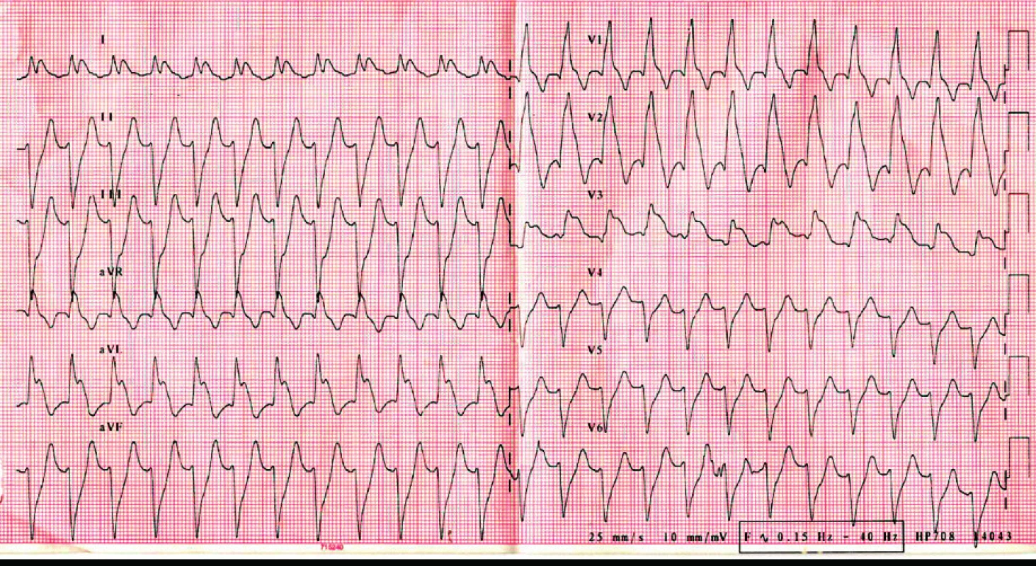 EKG křivka po přijetí na metabolickou jednotku. Popis EKG křivky je uveden v textu