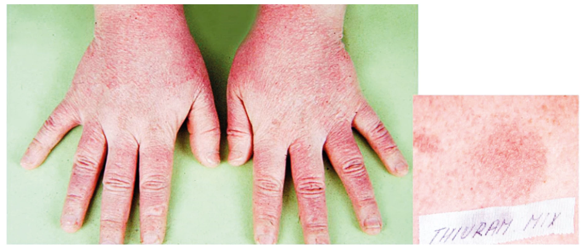 Eczema contactum prof. – guma rukavic – Thiuram-mix – pomocnice ve zdravotnictví