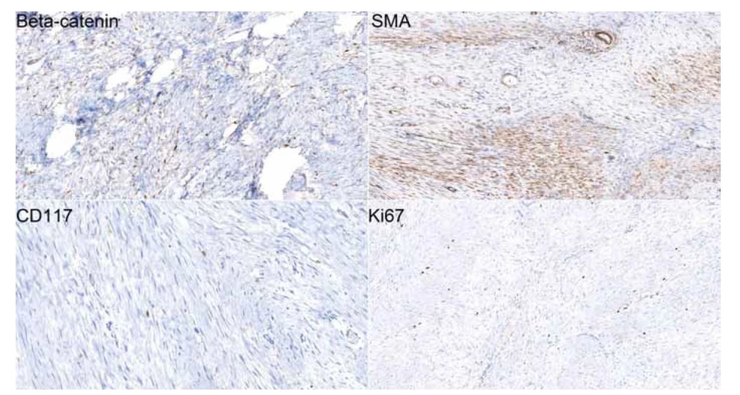 Imunohistochemické preparáty (20x) dokumentující jadernou pozitivitu beta-cateninu a cytoplazmatickou pozitivitu
hladkosvalového aktinu (SMA) ve významné části buněčnosti léze. CD117 (c-kit) je v buňkách léze negativní, je patrná
membránová pozitivita žírných buněk coby vnitřní kontrola. Proliferační aktivita (Ki67) léze je nízká s pozitivitou nepřesahující
5 % buněk.<br>
Fig. 3. Immunohistochemical slides (20x) showing beta-catenin nuclear positivity and cytoplasmic positivity of smooth muscle
actin (SMA) in a signifi cant part of the cellular lesion. CD117 (c-kit) is negative in tumorous cells, membrane positivity of mast cells
which was used as means of internal control is evident. The proliferative activity (Ki67) of the tumor is low with cellular positivity not
exceeding 5%.