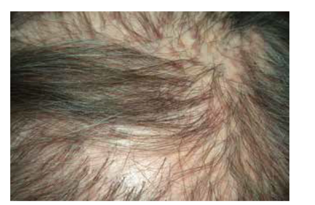 Lichen planopilaris kštice: jizvící alopecie, folikulárně
vázané červenofialové makulopapuly