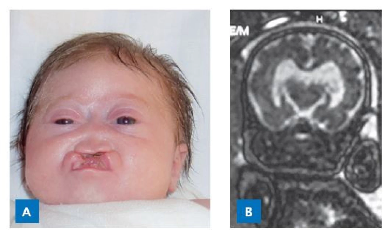 Dívka se semilobární holoprosencefalií v důsledku mutace
SHH genu. Narodila se s rozštěpem rtu a patra, deformací nosu, hypotelorismem,
mikrocefalií a závažnou deformací mozku. Trpěla poruchami
termoregulace, neurogenní hypernatremií, deficitem ACTH,
ale zejména progredujícími křečemi s apnoickými pauzami a desaturacemi
na podkladě heteropie mozkové tkáně. A – ve věku 2 měsíců.
B– fetální MR v gestačním věku 30 týdnů.