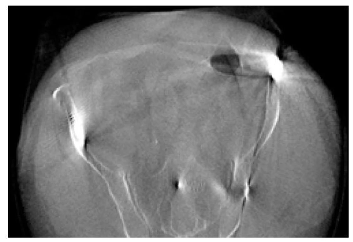 CT sken po zavedení šroubu na operačním sále O arm přístrojem