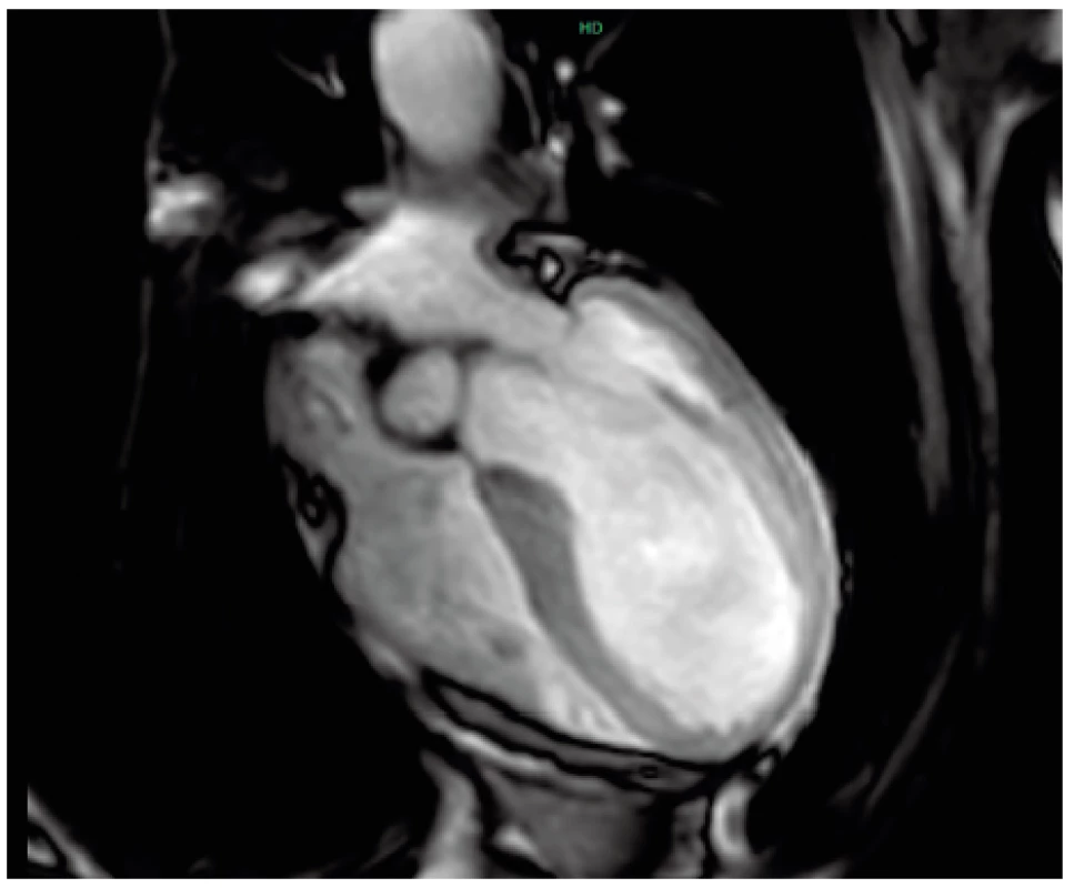  a MR vyšetření, kinetická sekvence, diastola.<br>
Obvyklý tvar nedilatovaných srdečních komor v diastole.