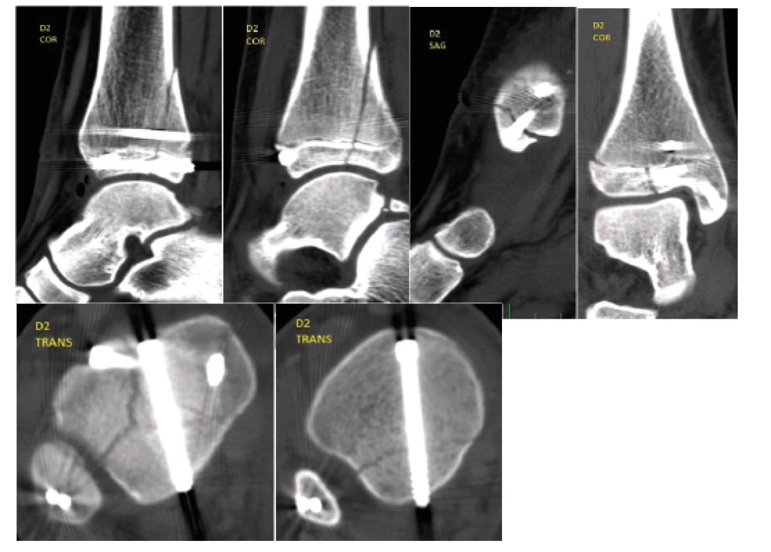 Control CT examination with multiplanar reconstructions, which confirmed a very good position of the fragments