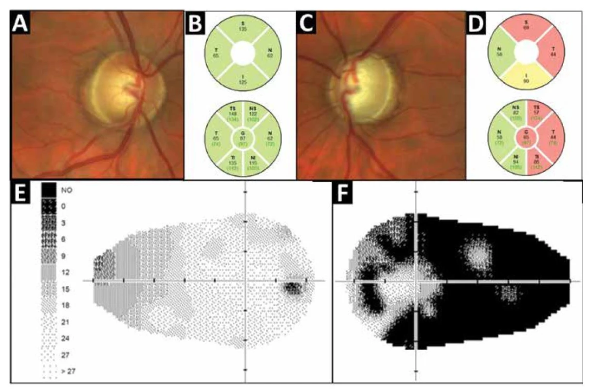 Oční vyšetření probanda z rodiny č. 2 v době první návštěvy na našem pracovišti. Barevná fotografie fundu pravého
(A) a levého oka (C) zobrazuje výraznou asymetrii mezi exkavacemi papil zrakového nervu. Statická automatická perimetrie
(glaukomový program) dokumentující markantní asymetrii mezi rozsahem zorného pole pravého (E) a levého oka (F), odpovídající
měření peripapilární tloušťky RNFL pravého (B) a levého oka (D)