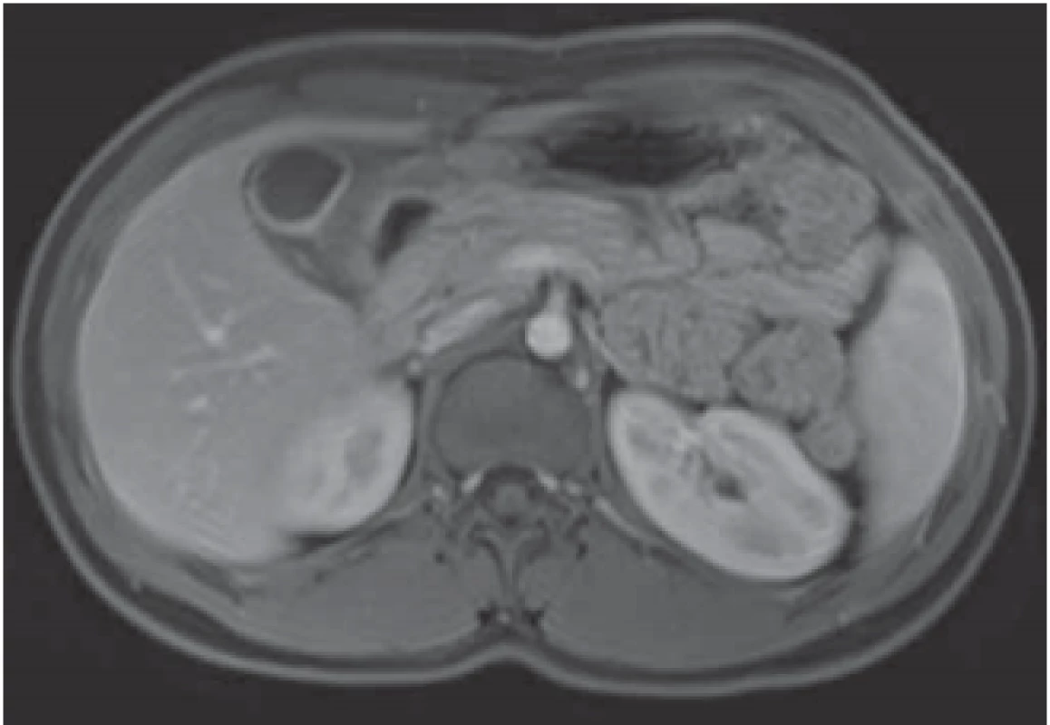 MRI – marked thickening of the duodenal wall with
retraction to the gallbladder.<br>
Obr. 1. MR – zesílení stěny duodena, které je retrahováno ke
žlučníku.
