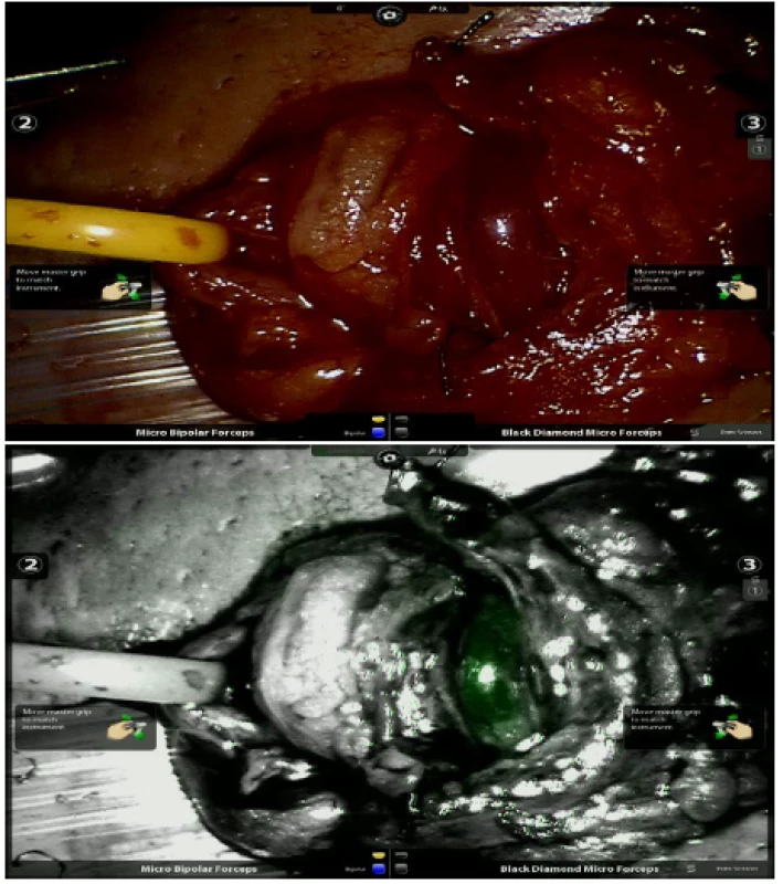 a, b. Zobrazení artérie při mikroskopické varikokélektomii před (a) a po aplikaci ICG (b)<br>
Fig. 3a, b. Imaging of artery before (a) and after the application of ICG (b) during microvaricocelectomy