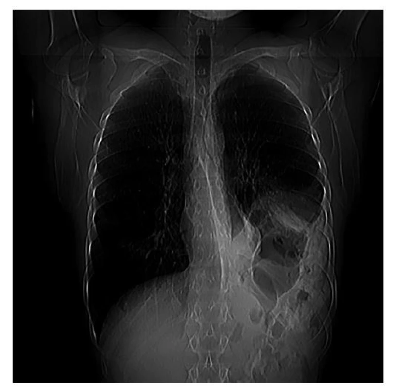 Herniace útrob do levé pleurální dutiny na CT topogramu<br>
Fig. 1: Visceral herniation in the left pleural cavity based
on CT topogram