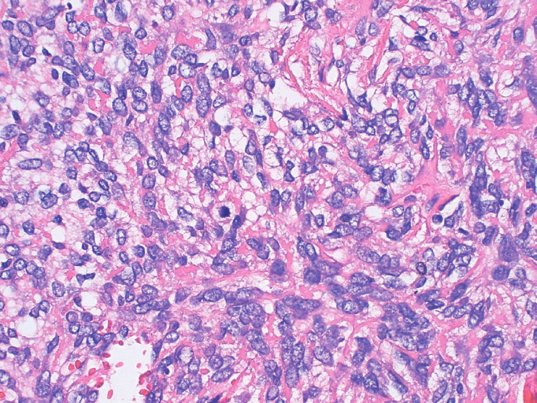 Oblasť nádoru so strednou atypiou nádorových buniek
a zachytenou mitotickou figúrou (v strede obrázka) (farbenie hematoxylín
a eozín, zväčšenie 400x).