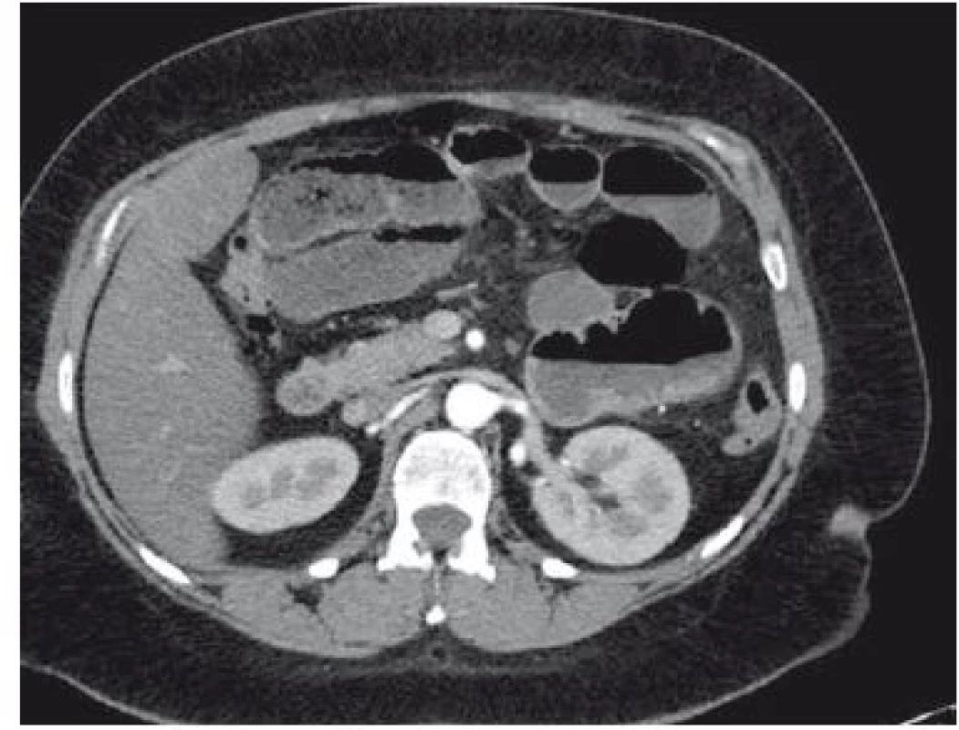 CT obraz dilatované tenké kličky.
Fig 3. CT scan of dilated small intestine.