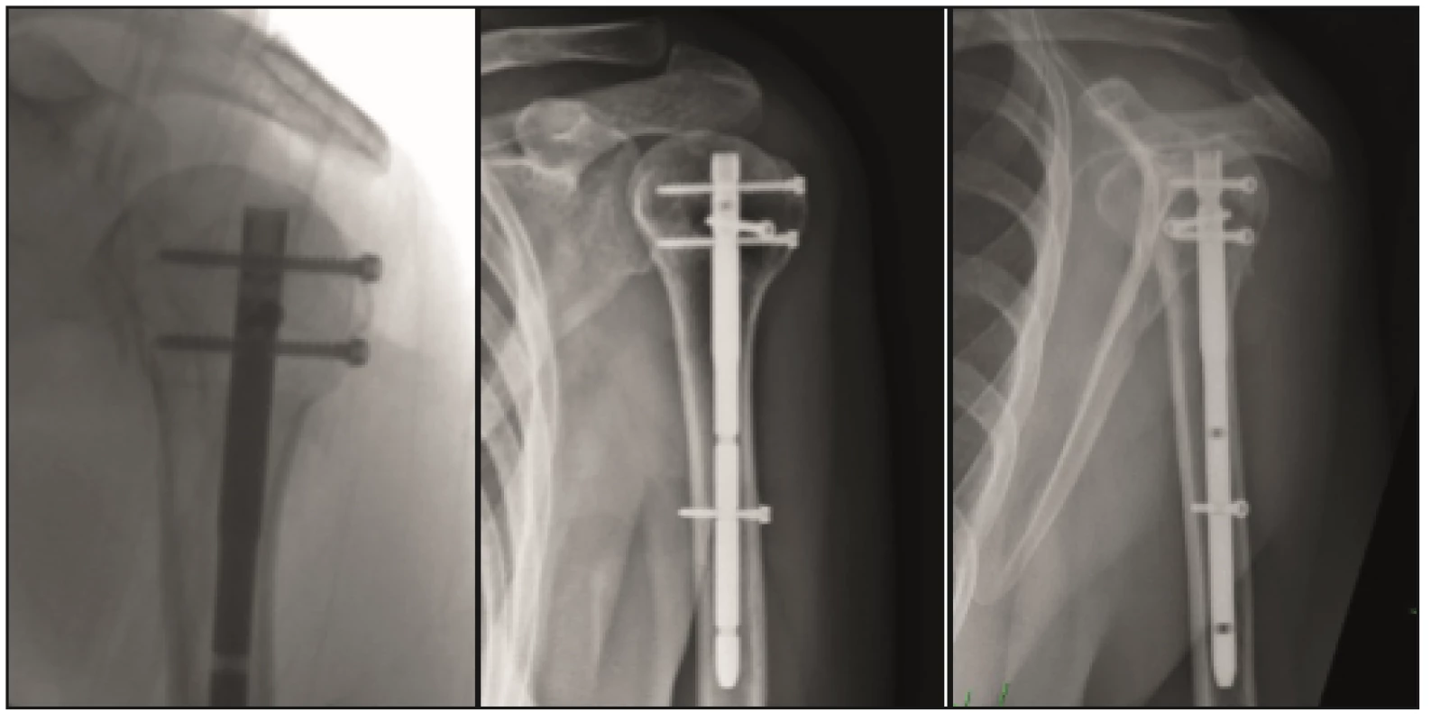 Woman 58 years old, AO B1.1 fracture, fall due to tripping, operation on day 1 after the injury. X-ray healing in 14 weeks; redress + arthroscopy in 8 months, resulting elevation of 160°