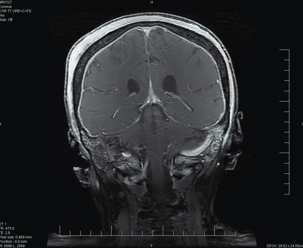 MRI hlavy (koronární projekce; T1).