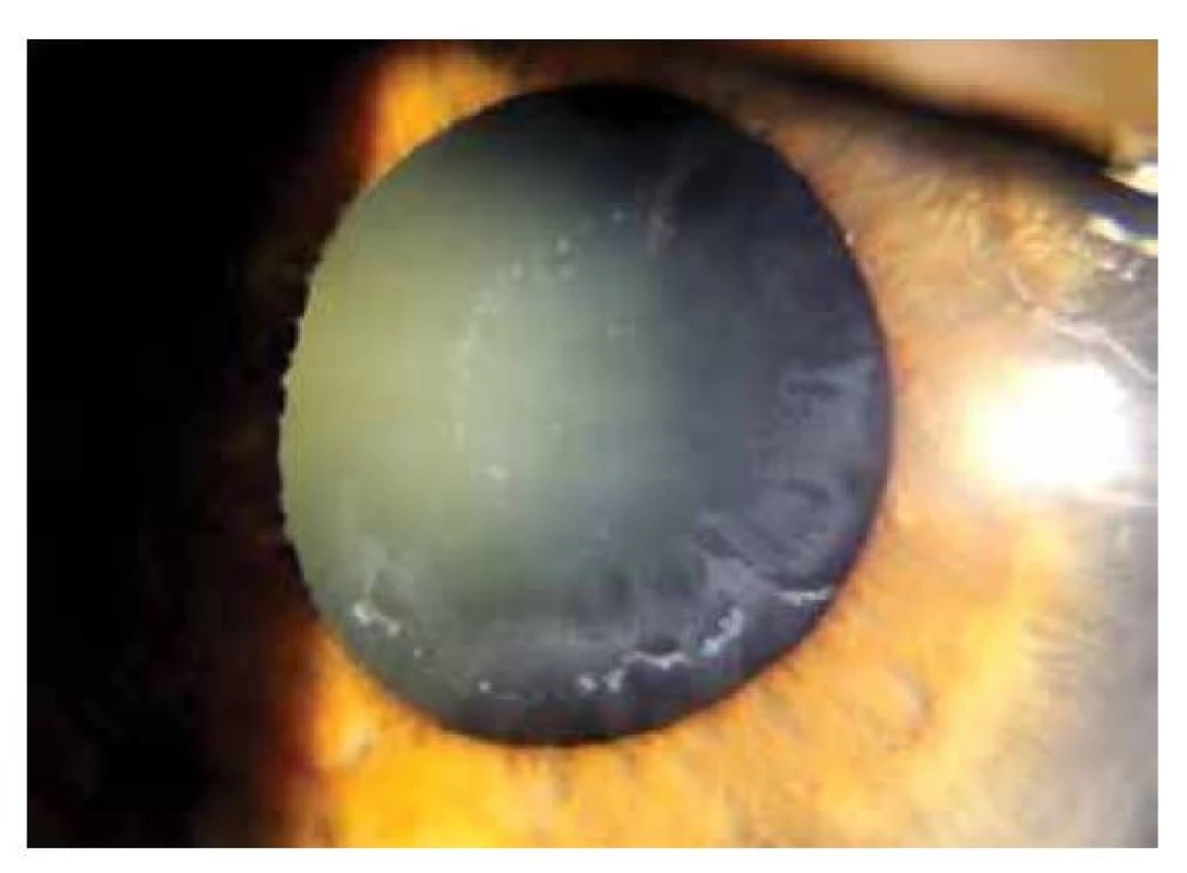 Patrná slabá arteficiální mydriáza (oko totožného
pacienta z obrázku č. 2 před instilací mydriatik)