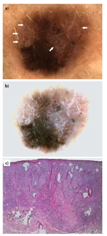 Pacientka, 48 let, nodulární melanom (Breslow 2,19 mm)
z dorzální strany levého předloktí<br>
a) dermatoskopický obraz s přítomností jasných bílých
proužků (šipky)<br>
b) normalizovaný dermatoskopický obraz, který jasné bílé
proužky zvýrazní.<br>
c) histopatologický obraz (HE, 40x).