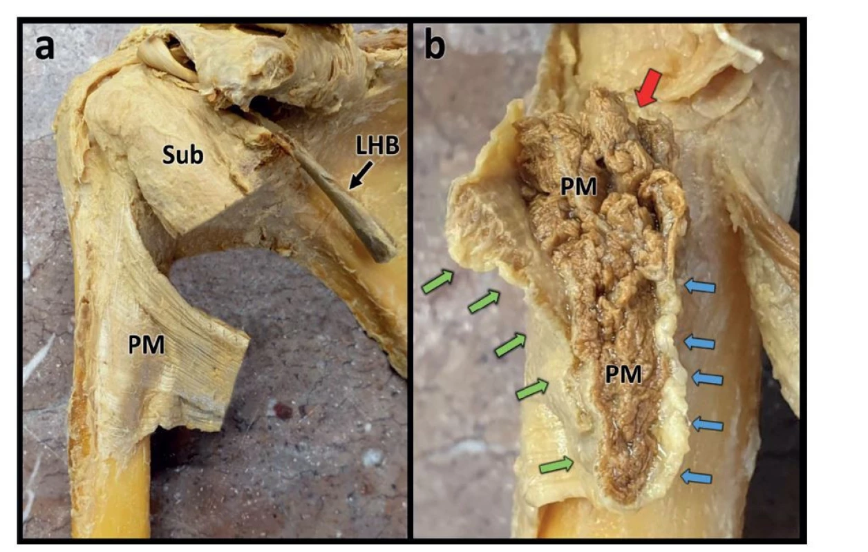 Detail úponu šlachy m. pectoralis major<br>
Fig. 2: Detail of the insertion of pectoralis major tendon