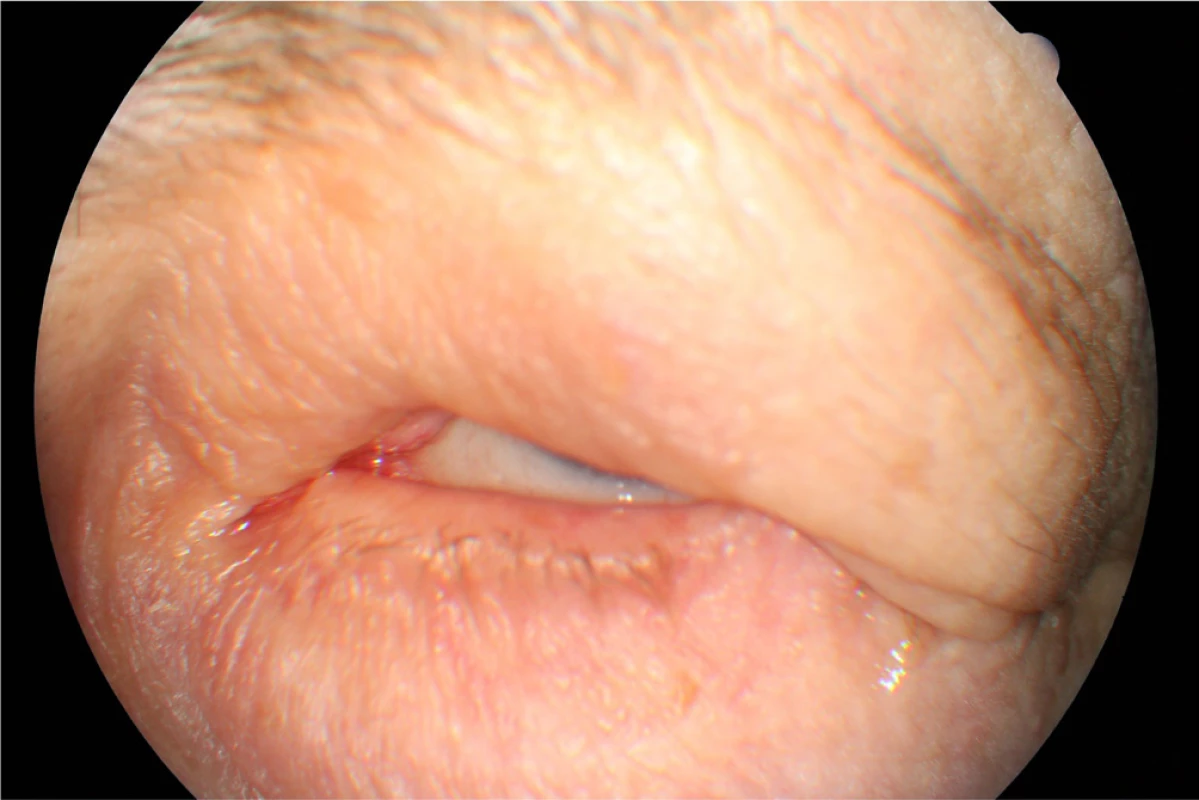 Clinical findings Patient 1 in year 2015 by the maximum
effort to close the eyelids