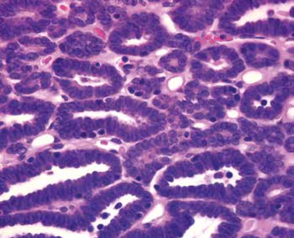 Tightly packed small uniform tumor cells with the hyperchromatic
round to oval partially overlapping nuclei and scant cytoplasm. Nucleoli and
mitotic figures are not apparent (HE, 630x).